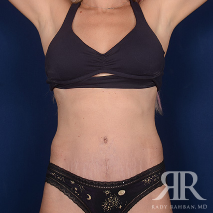 Tummy Tuck