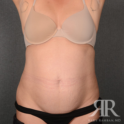 Tummy Tuck