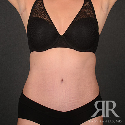 Tummy Tuck