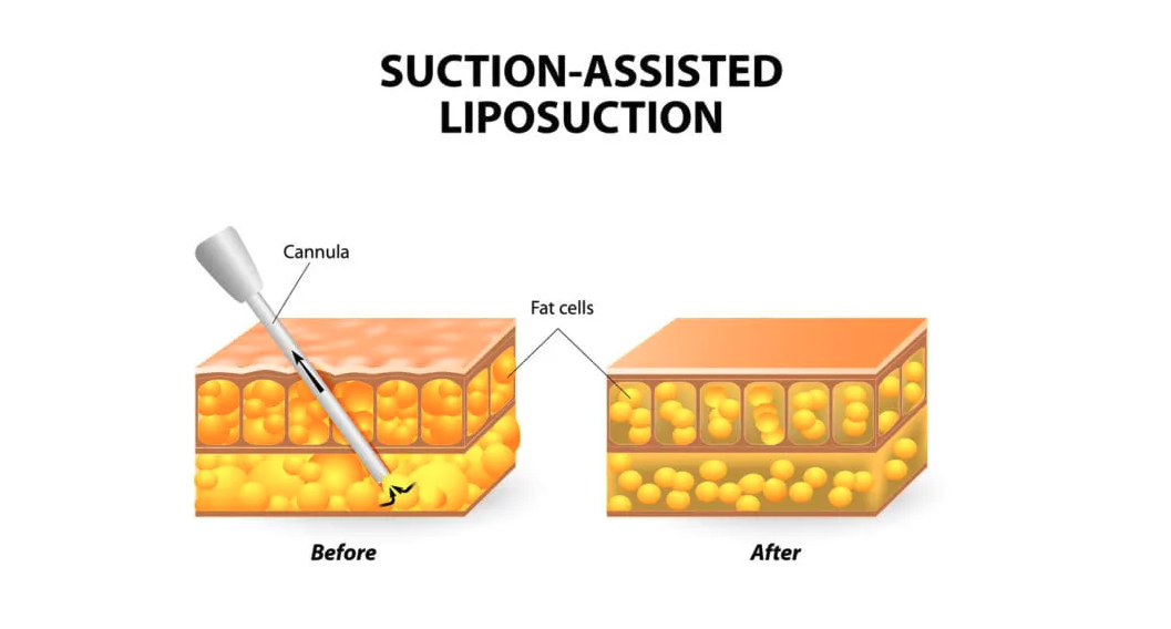 drawn example of how Liposuction works