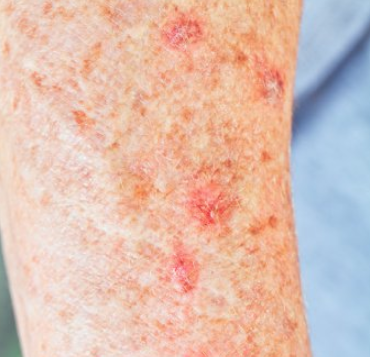 Example of actinic keratosis