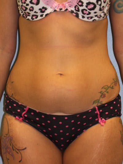 Liposuction Before & After Gallery - Patient 5794623 - Image 1