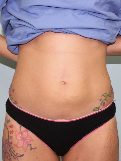 Liposuction Before & After Gallery - Patient 5794623 - Image 2