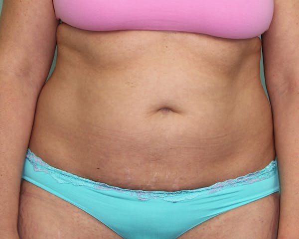 Liposuction Before & After Gallery - Patient 5794624 - Image 1
