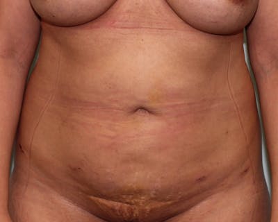 Liposuction Before & After Gallery - Patient 5794624 - Image 2