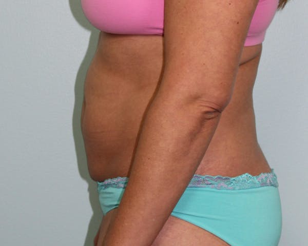 Liposuction Before & After Gallery - Patient 5794624 - Image 3