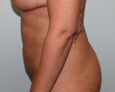 Liposuction Before & After Gallery - Patient 5794624 - Image 4