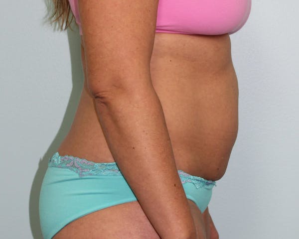 Liposuction Before & After Gallery - Patient 5794624 - Image 5