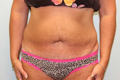 Tummy Tuck (Abdominoplasty) Before & After Gallery - Patient 5794628 - Image 1