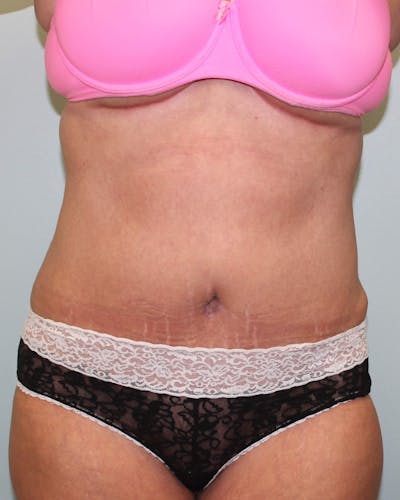 Tummy Tuck (Abdominoplasty) Before & After Gallery - Patient 5794628 - Image 2