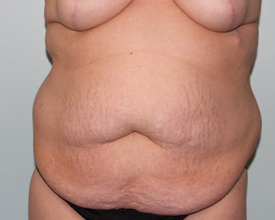 Tummy Tuck (Abdominoplasty) Before & After Gallery - Patient 5794629 - Image 1