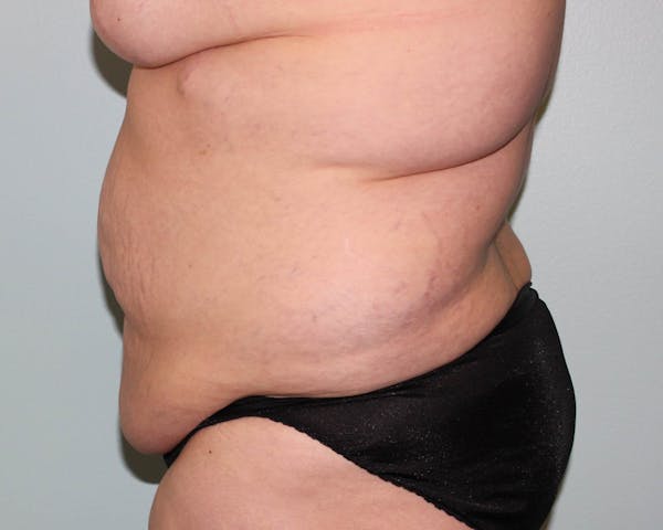 Tummy Tuck (Abdominoplasty) Before & After Gallery - Patient 5794629 - Image 3