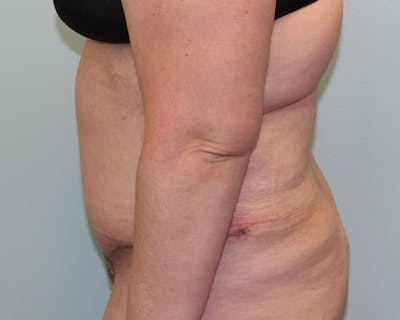 Tummy Tuck (Abdominoplasty) Before & After Gallery - Patient 5794629 - Image 4