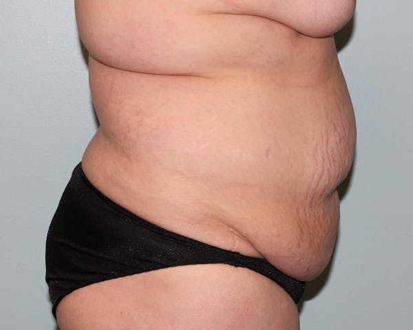 Tummy Tuck (Abdominoplasty) Before & After Gallery - Patient 5794629 - Image 5