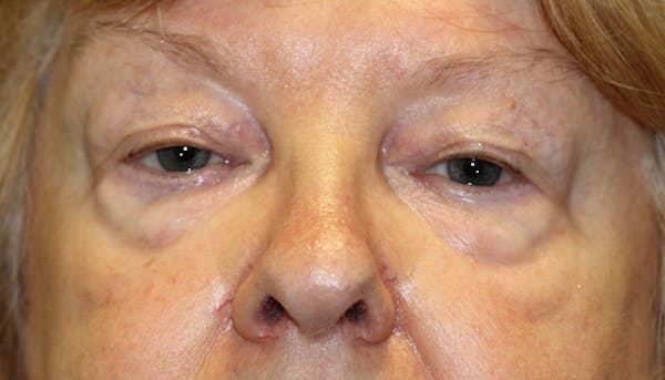 Eyelid Lift (Blepharoplasty) Before & After Gallery - Patient 5794630 - Image 1