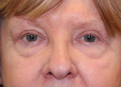Eyelid Lift (Blepharoplasty) Before & After Gallery - Patient 5794630 - Image 2