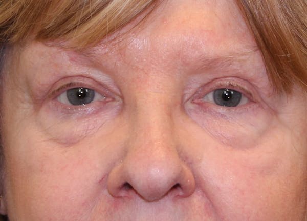 Eyelid Lift (Blepharoplasty) Before & After Gallery - Patient 5794630 - Image 2