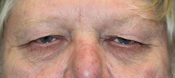 Eyelid Lift (Blepharoplasty) Before & After Gallery - Patient 5794631 - Image 1