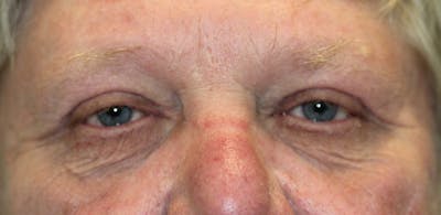Eyelid Lift (Blepharoplasty) Before & After Gallery - Patient 5794631 - Image 2