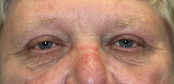 Eyelid Lift (Blepharoplasty) Before & After Gallery - Patient 5794631 - Image 2