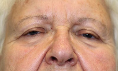 Eyelid Lift (Blepharoplasty) Before & After Gallery - Patient 5794632 - Image 1