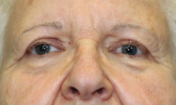 Eyelid Lift (Blepharoplasty) Before & After Gallery - Patient 5794632 - Image 2