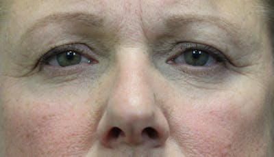 Eyelid Lift (Blepharoplasty) Before & After Gallery - Patient 5794634 - Image 1