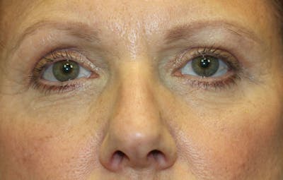 Eyelid Lift (Blepharoplasty) Before & After Gallery - Patient 5794634 - Image 2