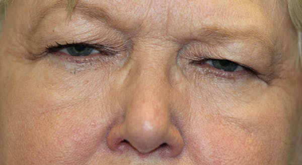 Eyelid Lift (Blepharoplasty) Before & After Gallery - Patient 5794635 - Image 1