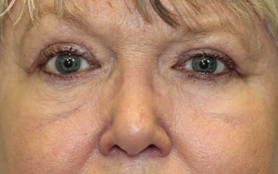 Eyelid Lift (Blepharoplasty) Before & After Gallery - Patient 5794635 - Image 2