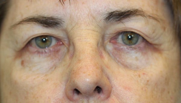 Eyelid Lift (Blepharoplasty) Before & After Gallery - Patient 5794637 - Image 1