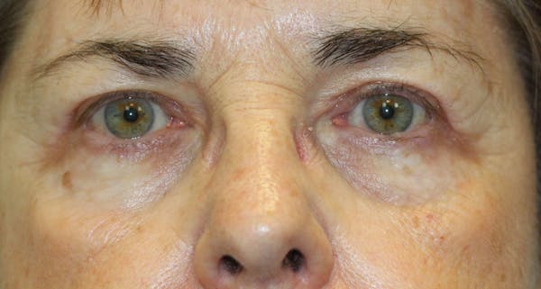 Eyelid Lift (Blepharoplasty) Before & After Gallery - Patient 5794637 - Image 2
