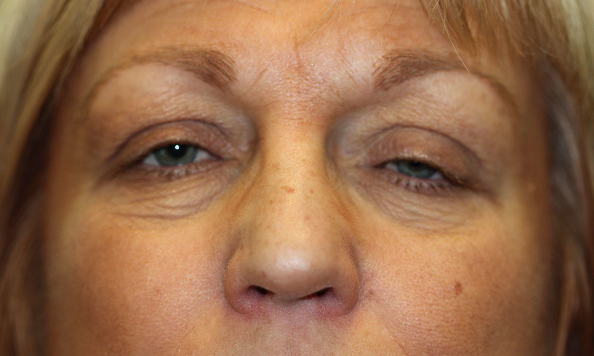 Eyelid Surgery