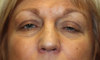 Eyelid Lift (Blepharoplasty) Before & After Gallery - Patient 5794638 - Image 1