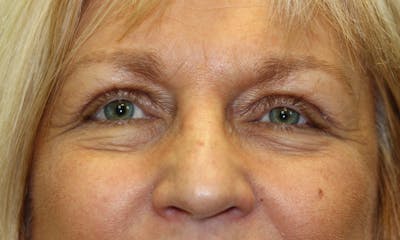 Eyelid Lift (Blepharoplasty) Before & After Gallery - Patient 5794638 - Image 2