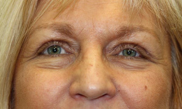 Eyelid Lift (Blepharoplasty) Before & After Gallery - Patient 5794638 - Image 2