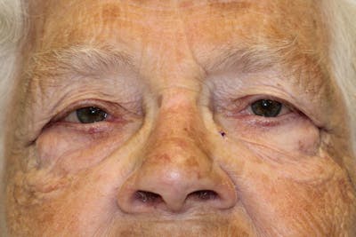 Eyelid Lift (Blepharoplasty) Before & After Gallery - Patient 5794639 - Image 2