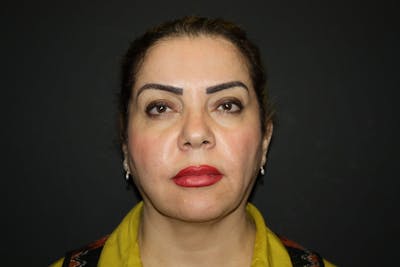Facelift Before & After Gallery - Patient 5794651 - Image 1