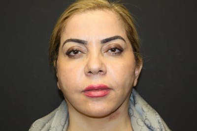 Facelift Before & After Gallery - Patient 5794651 - Image 2