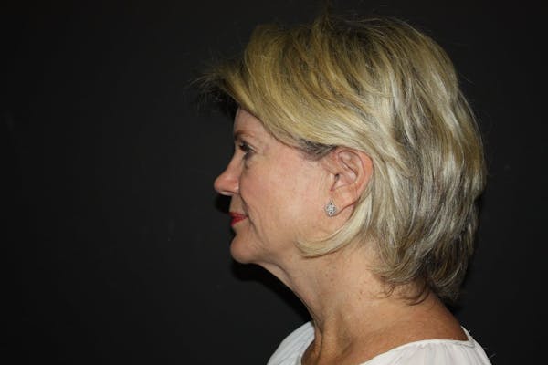Facelift Before & After Gallery - Patient 5794652 - Image 3