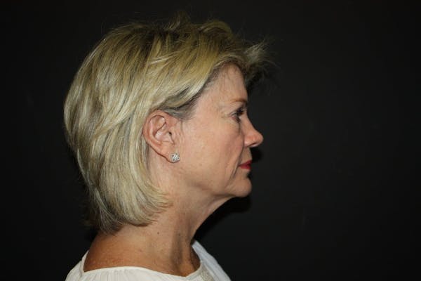 Facelift Before & After Gallery - Patient 5794652 - Image 5