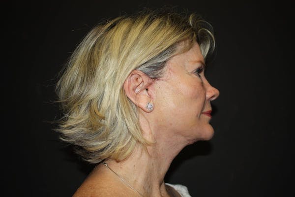 Facelift Before & After Gallery - Patient 5794652 - Image 6