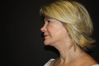 Facelift Before & After Gallery - Patient 5794652 - Image 4