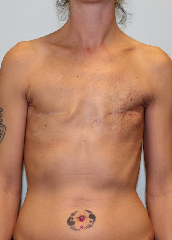 Breast Reconstruction Before & After Gallery - Patient 5799693 - Image 1