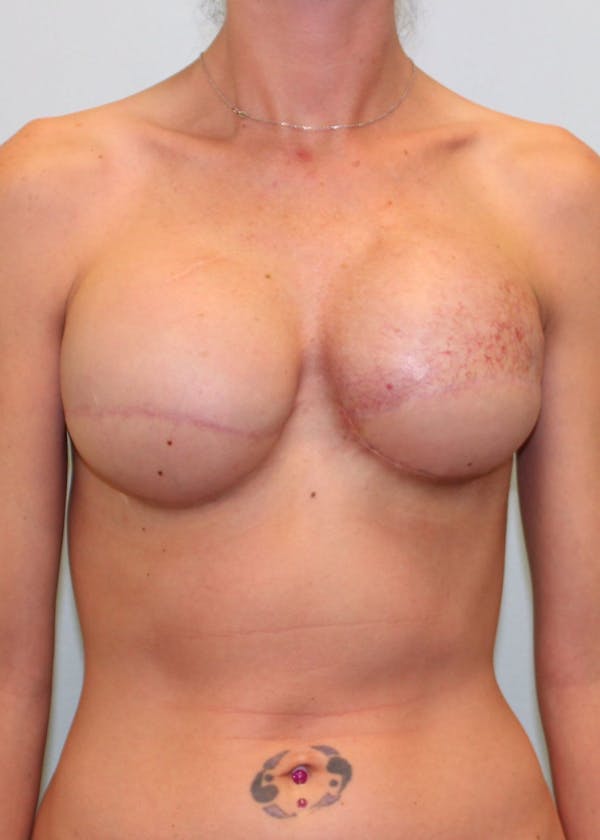 Breast Reconstruction Before & After Gallery - Patient 5799693 - Image 2