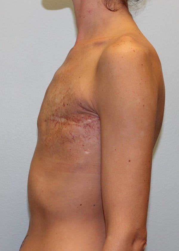 Breast Reconstruction Before & After Gallery - Patient 5799693 - Image 3