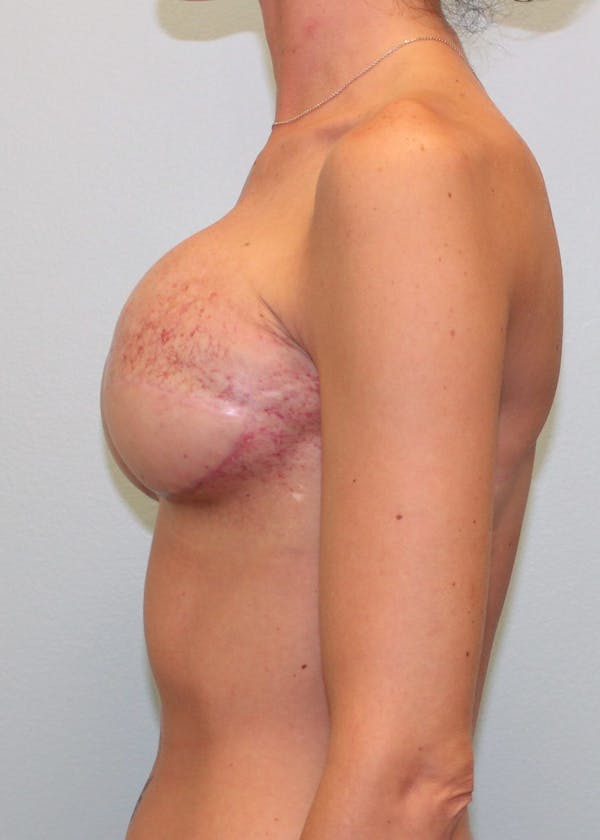 Breast Reconstruction Before & After Gallery - Patient 5799693 - Image 4