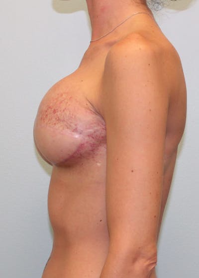 Breast Reconstruction Before & After Gallery - Patient 5799693 - Image 4