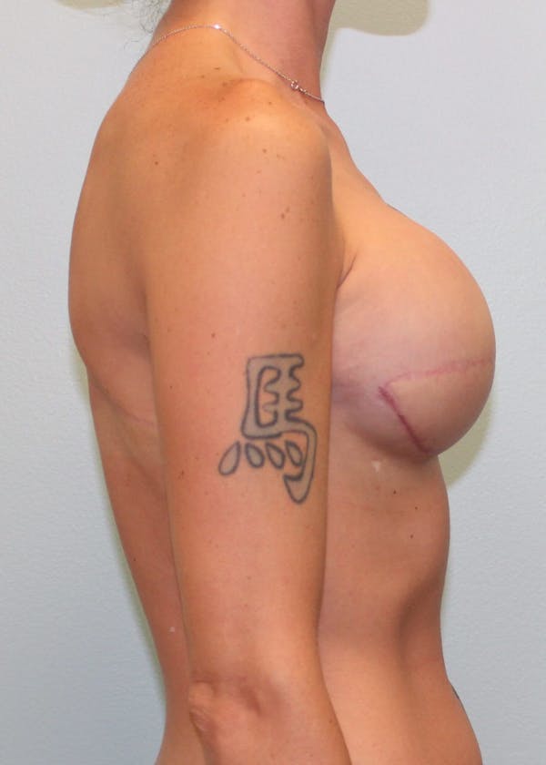 Breast Reconstruction Before & After Gallery - Patient 5799693 - Image 6