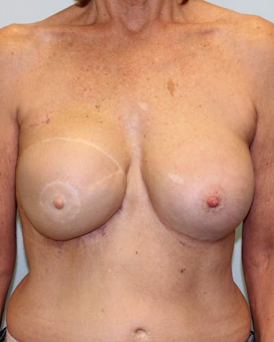 Breast Reconstruction Before & After Gallery - Patient 5799696 - Image 2